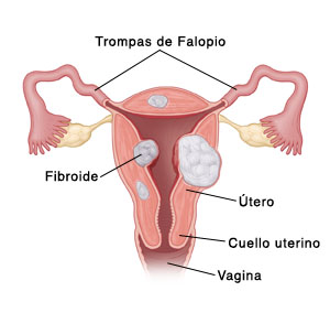 Coronal section of uterus showing fibroids SOURCE: 116004 MOD: added fibroids